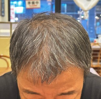 정수리탈모 후